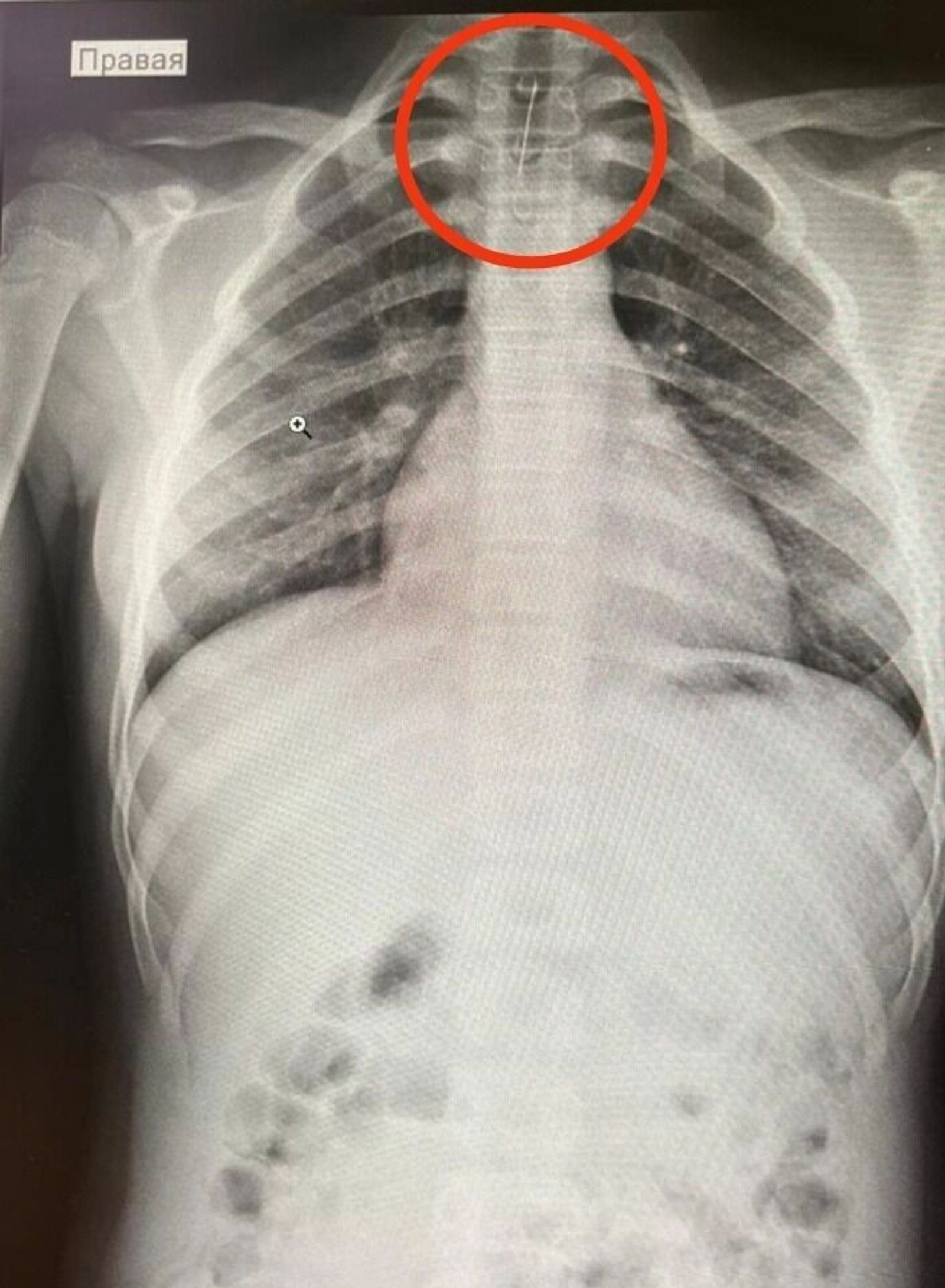 В Башкирии 14-летняя девочка случайно проглотила иголку